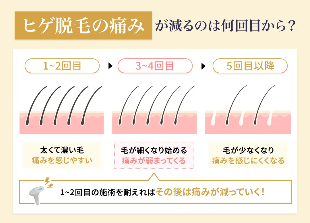ヒゲ脱毛で痛みが減っていく回数の目安