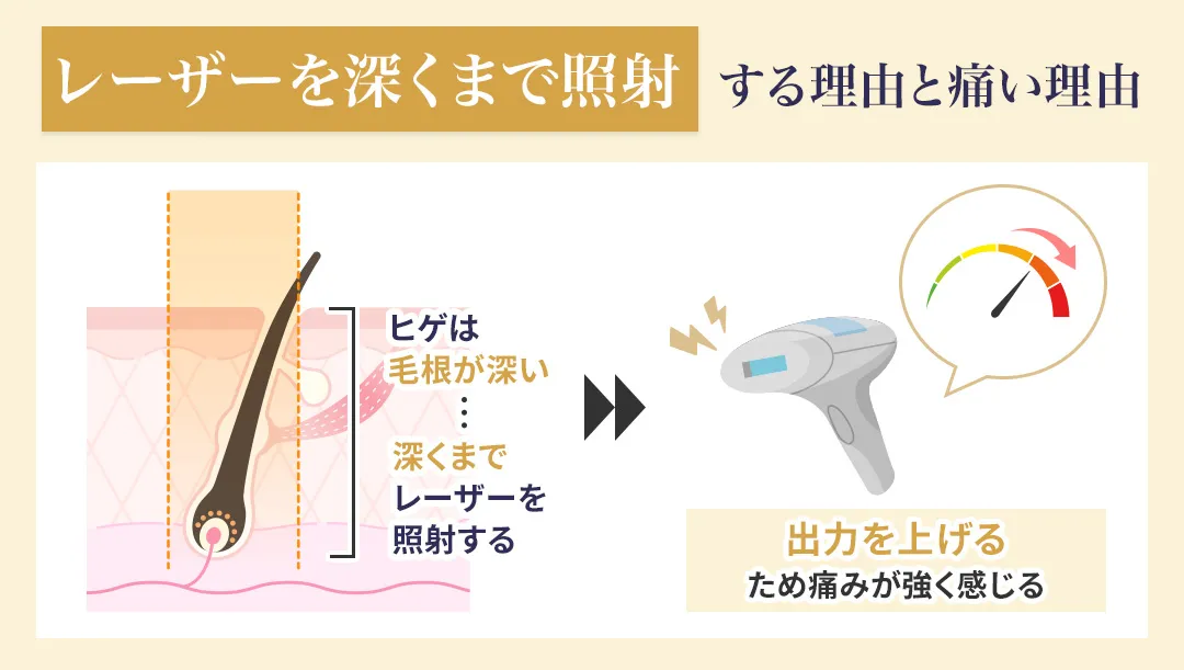 レーザーを皮膚の深くまで照射する理由と痛みが強い理由
