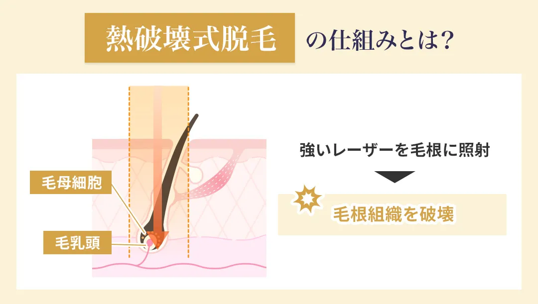 熱破壊式の医療脱毛の仕組みについて
