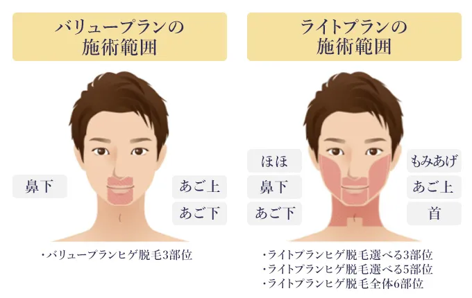 エミナルクリニックメンズヒゲ脱毛の施術範囲