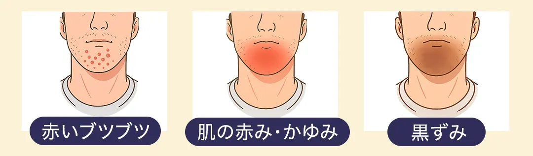 髭剃りの肌荒れで発症する症状について