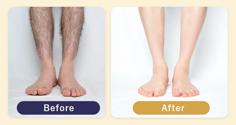 すね毛の脱毛前と脱毛後を比較している画像