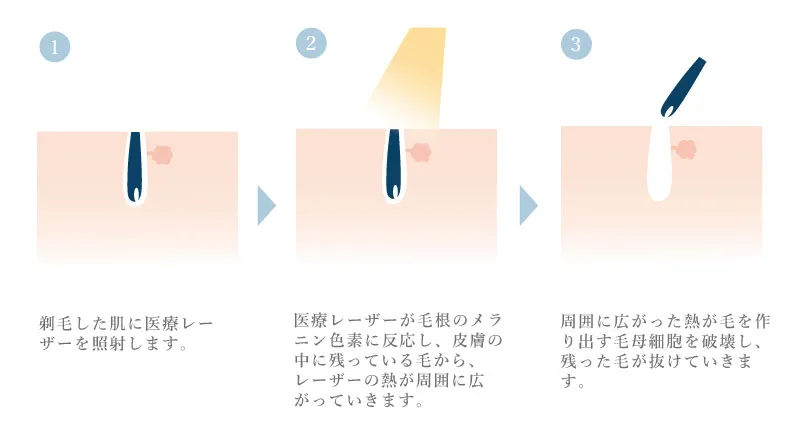 ヒゲ脱毛の仕組み