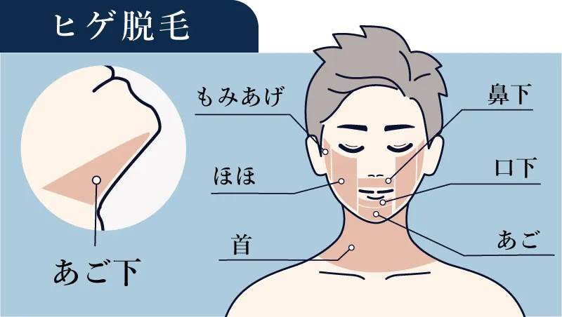 ヒゲ脱毛の施術に含まれる範囲