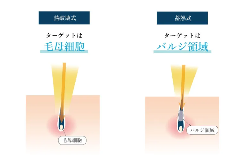 ヒゲの医療脱毛の二つの脱毛方式