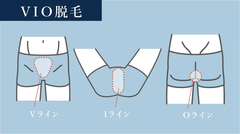 メンズのVIO脱毛に含まれる範囲